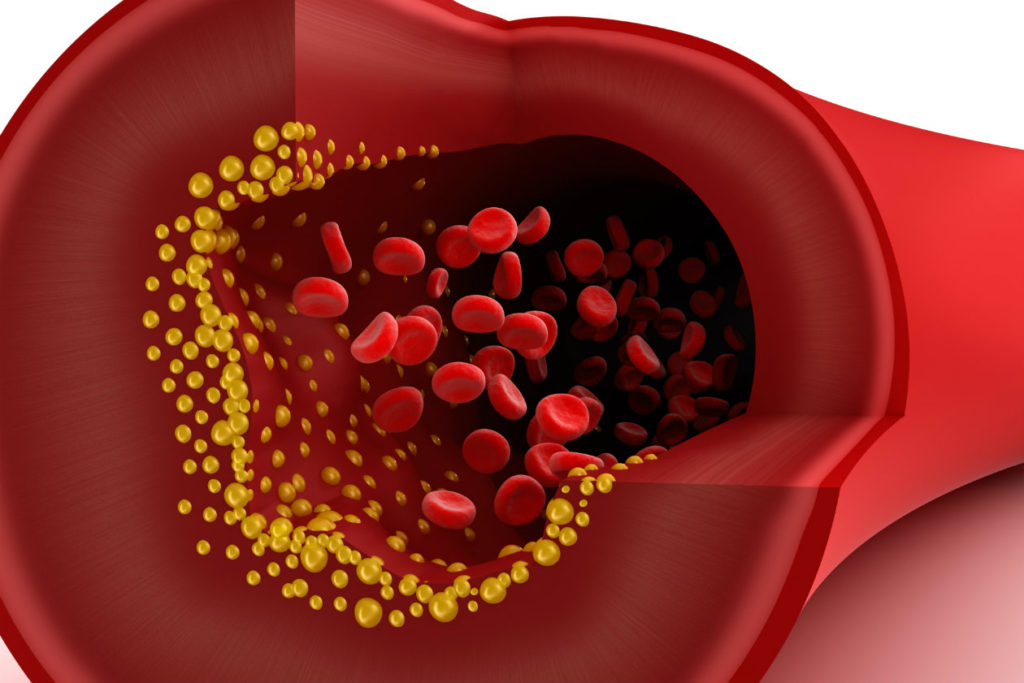 Mikor veszélyes a magas koleszterin szint?